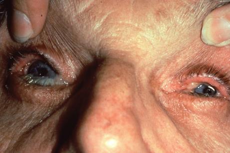 Ocular Cicatricial Pemphigoid Brunsting-Perry