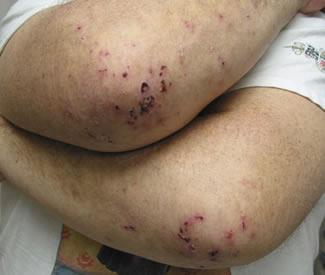 Dermatitis Herpetiformis (Pathophysiology - Simplified) Genetic