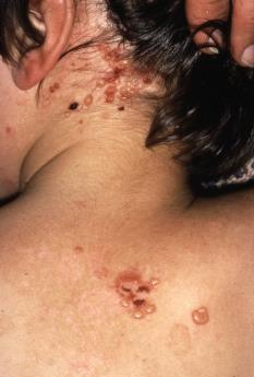 Linear IgA Bullous Dermatosis Clinical Features Chronic bullous disease of childhood Typically before 5 years of age
