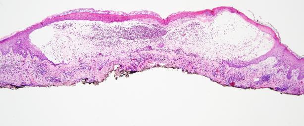 Bullous Pemphigoid (Histology) Shave biopsy is a beautiful way to go!