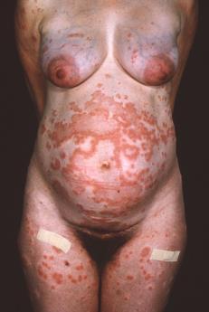 2008 Herpes Gestationis (Pemphigoid