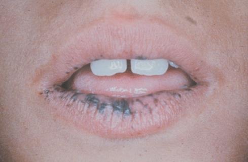 Frecklelike lesions of the hands, perioral skin, and oral mucosa + intestinal polyposis