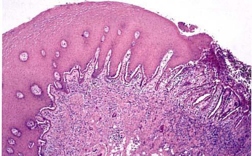 Histopathologic features Biopsy specimens of peri lesional tissue show characteristic