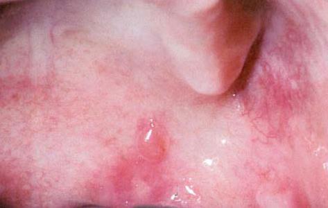 Clinical features The oral lesions of pemphigoid begin as either