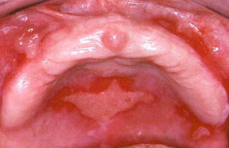 Clinical features The oral blisters rupture, leaving large, superficial, ulcerated, and