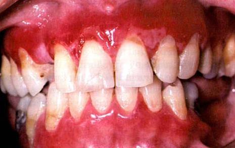 Clinical features Gingival involvement produces a