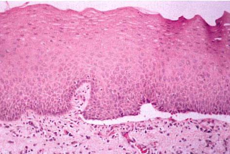 Histopatholgic features Biopsy of perilesional mucosa shows a split