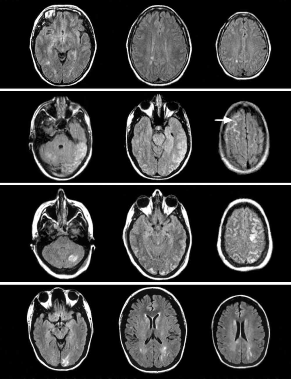 A B C D Figure 1. Brain magnetic resonance imaging (MRI) fluid-attenuated inversion recovery sequences. A, Patient 1.