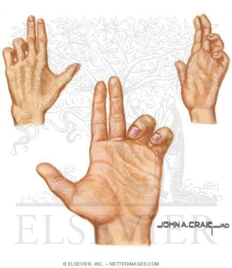 Functional anatomy The benediction hand deformity results from damage to the ulnar nerve.
