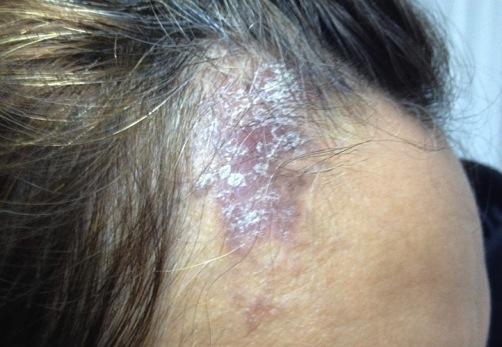 Physical examination showed multiple slightly hyperpigmented violaceous, discrete, raised papules and plaques in linear fashion. Notice the lesion scales on one side of the right forehead.