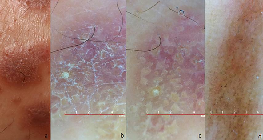 C D Figure 2. Clinical and dermoscopic images of a CLP patient. () Multiple discrete, violaceous, polygonal papules on the leg. () Dermoscopic examination without gel.