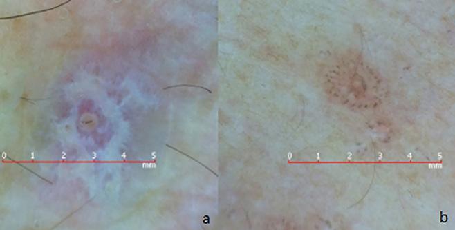 [Copyright: 2015 Güngör et al.] Figure 3. () White reticular-circular WS surrounded by red dots of a CLP patient. () Peripheral brown dots in circular arrangement of the same lesion after treatment.