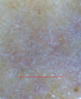 () Diffuse brown dots and reticulated pigmentation on a brown background after three months of treatment of the same patient. [Copyright: 2015 Güngör et al.] cular WS in four lesions (13.