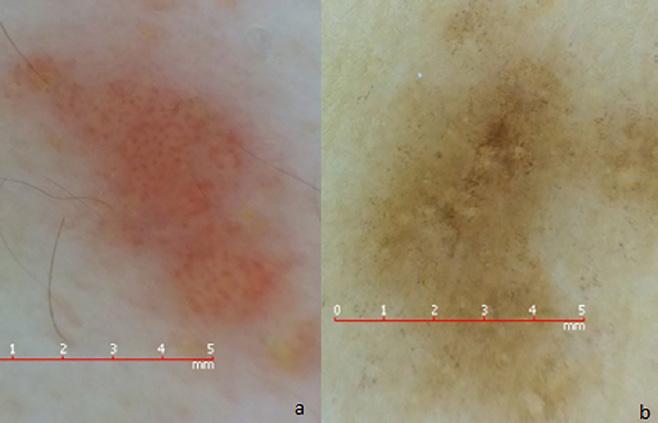In two GLP lesions, a circular space between diffuse red dots were observed; as it is consistent with the same patients other lesions WS configuration, we defined this lesion as invisible WS.
