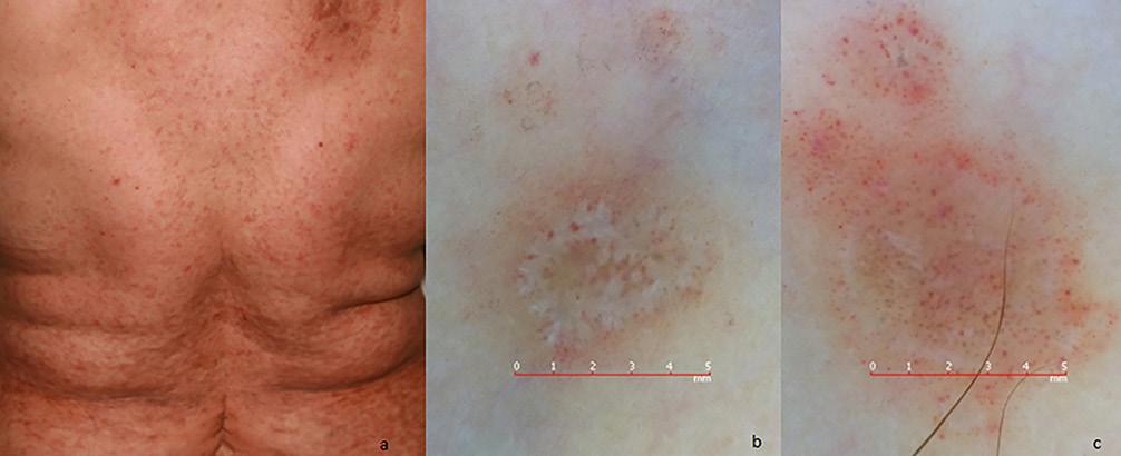 Vascular patterns were observed in 24 of 30 GLP lesions (80%). These were sub-grouped as perifollicular red dots in six lesions (20%), peripheral red dots in five lesions (16.