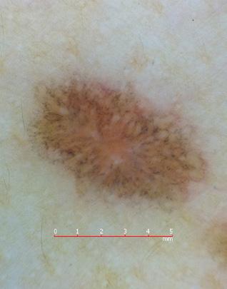 () Perifollicular-annular pigmentation and white dots in an LPPI patient. [Copyright: 2015 Güngör et al.] in 13 of 15 LPp lesions (86.