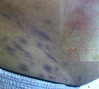 (C) The dermoscopic image of the same lesion after four weeks, the pigmentation pattern was changed to reticular