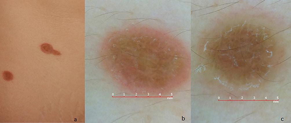 C Figure 15. Clinical and dermoscopic images of an annular atrophic LP patient with a two-week history. () Numerous 0.5-1.5 cm annular plaques on the trunk.