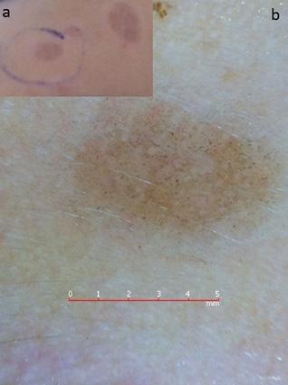 () n annular plaque with central pigmentation on the patient s back. () Linear white annular WS, perifollicular-annular pigmentation on a brown background is seen upon dermoscopic examination.