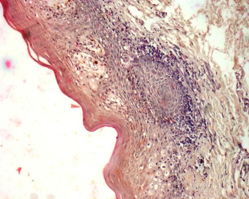 Figure 2a: Photomicrograph showing Keratinized