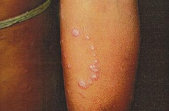 Figure 3: Showing classical lesions present on flexor aspect of forearm with koebnerisation Figure6- showing histopathological features of dermis in cutaneous LP Figure 4: Photograph showing