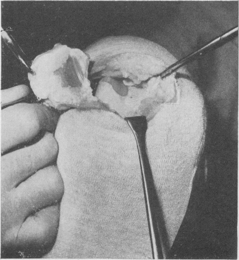 In addition, various "plastic" methods of reinforcing the gap by flaps or advancements with or without direct suture of quadriceps to patellar ligaments have been advised, but they are not widely