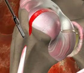 The surgeon will locate the biceps tendon and debride (remove) any frayed edges that occurred from the rupture.