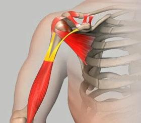The biceps tendon may also detach from the forearm distally, referred to as distal biceps tendon rupture, however this is less common.