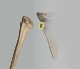 Unit 1: Biceps Tendon Rupture Normal Shoulder Anatomy Acromioclavicular Ligament Ligaments connect bone to bone, and acromioclavicular