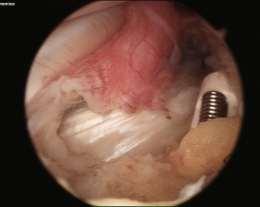 PREDISPOSING FACTORS RELATED TO THE OPERATIVE REPAIR ITSELF Revision rotator cuff repairs (particularly open technique) have been associated with lower success and higher complication rates.