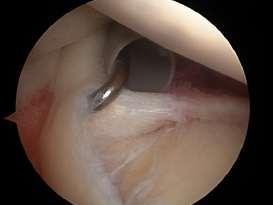 PREDISPOSING FACTORS FOR THE DEVELOPMENT OF STIFF SHOULDER The combination of a labral repair with rotator cuff