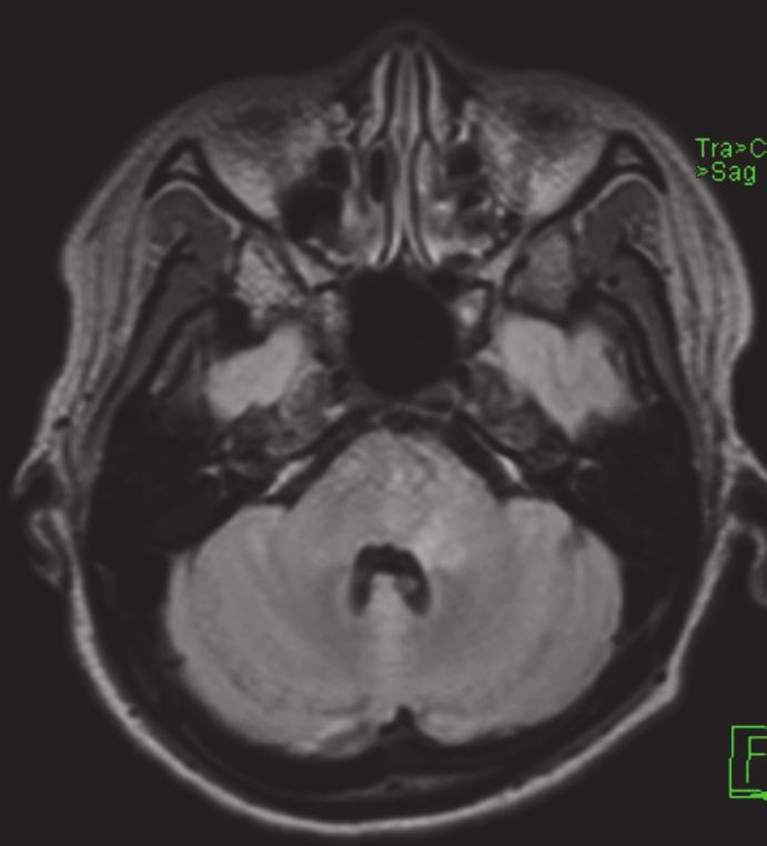 2 Case Reports in Neurological Medicine (a) (b) (c) Figure 1: (a) Axial T2/FLAIR and (b) axial and sagittal (c) T1 weighted MRI after IV gadolinium based contrast medium injection, showing