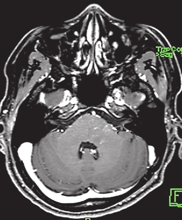 (a) (b) (c) Figure 2: (a) Sagittal T2/FLAIR, (b) sagittal, and (c) coronal T1 weighted MRI after IV gadolinium based contrast medium injection, of the brain, showing white matter ill-defined