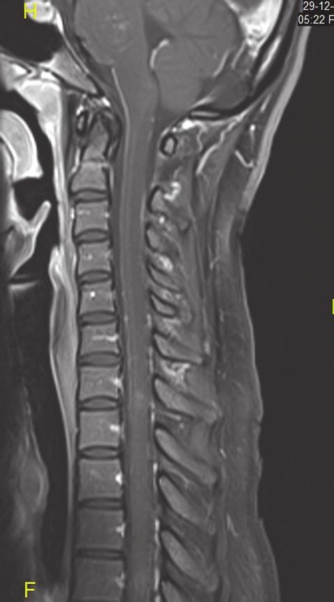 Case Reports in Neurological Medicine 3 (a) (b) Figure 3: Sagittal T1 weighted MRI after IV gadolinium based contrast medium injection, of the spinal cord, showing multifocal punctate and linear