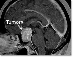 Transsphenoidal resection of pituitary brain tumours may account for as much as
