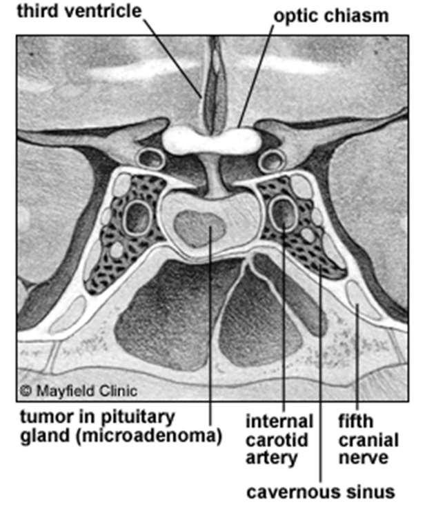 Intraoperative Complications Hemorrhage from carotid artery