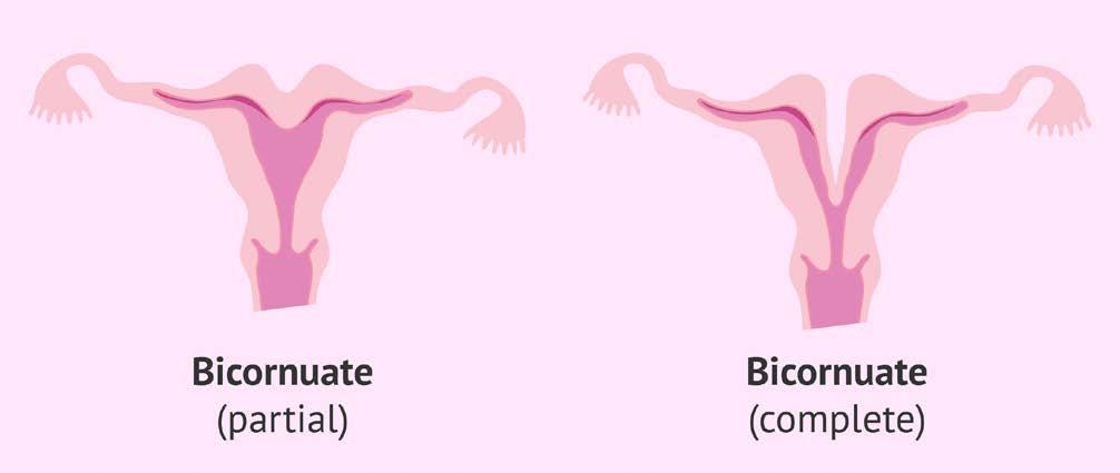 Bicornuate Uterus Due to incomplete fusion of mullerian ducts Results in two separate but