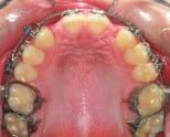 After eight weeks of second-molar distalization with