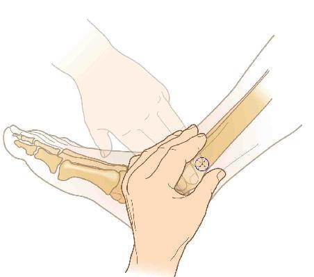 Adult distal tibial insertion: The insertion site is approximately two finger widths proximal to the medial malleolus and
