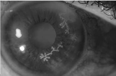 Anti-Viral Anti-Viral When: Herpes Simplex and Zoster/Shingles Viral Conjunctivitis Ocular Viroptic(trifluridine) Zirgan