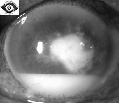 Ocular Natacyn Systemic Fluconazole Corneal Health Other Ocular Surface Disease Restasisand Xiidra Muro128 ABMD Recurrent corneal