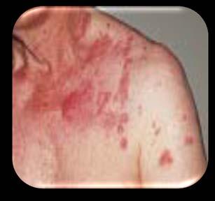 Abnormal Skin Sensations Headache Photophobia Malaise Unilateral Dermatomal Rash Cessation of New Vesicles Maculopapules/Vesicles