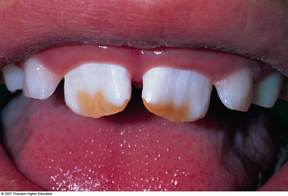 Fluoride Fluoride and Toxicity Tooth damage called fluorosis irreversible pitting and discoloration of the teeth Prevention of fluorosis Monitor fluoride content of local