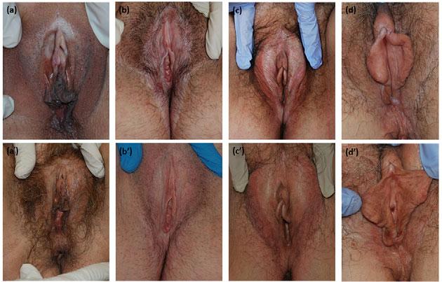 Clearance in vulvar lichen sclerosus 97 diseases such as lichen planus, vulvar intraepithelial neoplasia or plasma cell vulvitis; lack of agreement between clinical and histological features;