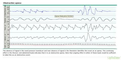 Gold standard is in-lab polysomnogram Home sleep studies may be acceptable IF Patient has history consistent with