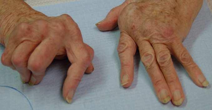 Whatever the cause, central to today's thinking about rheumatoid arthritis is the understanding