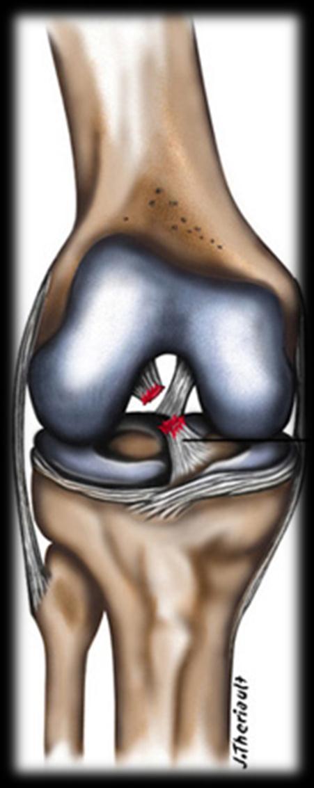 ACL tear ACL reconstruction -The