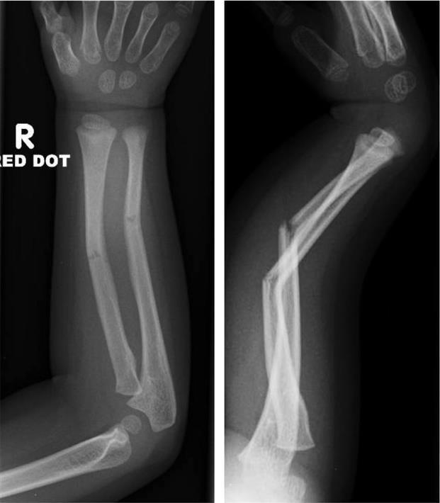 x 6-8 weeks Distal short arm cast