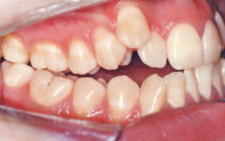 deficiency, a posterior crossbite, an open bite between the lateral incisors and the