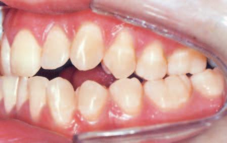 Crowding in the mandibular arch amounted to 3 mm.